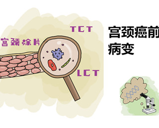 #HPV轉陰# NIC3錐切術后VaINI級、HPV陽性感染電灼結合紅卡治療#婦科宮頸健康#HPV超話健康超話#女性健康# ??? #HPV轉陰# NIC3錐切術后VaINI級、HPV陽性感染電灼結合紅卡治療#婦科宮頸健康#HPV超話健康超話#女性健康# ???