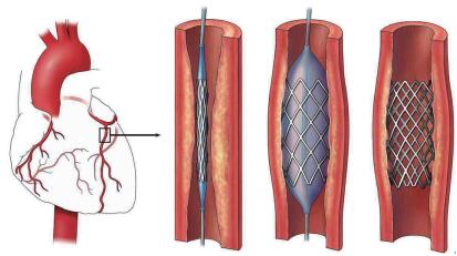 心髒血管支架等離子清洗機的應用