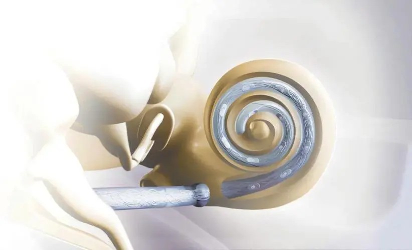 等離子表麵處理對人工耳蝸的重要作用