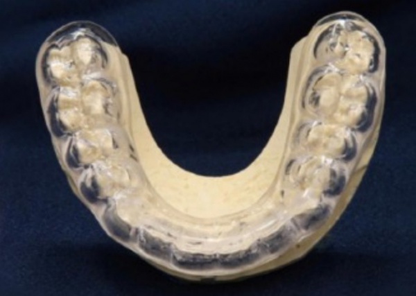 Full Ceramic Restorations