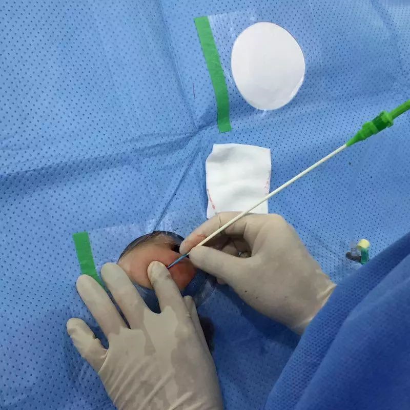 我院心血管内科成功完成首例桡动脉远端入路介入术