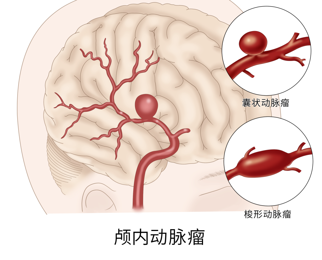顺德交警紧急开道，为颅内动脉瘤患者赢得宝贵救治时间