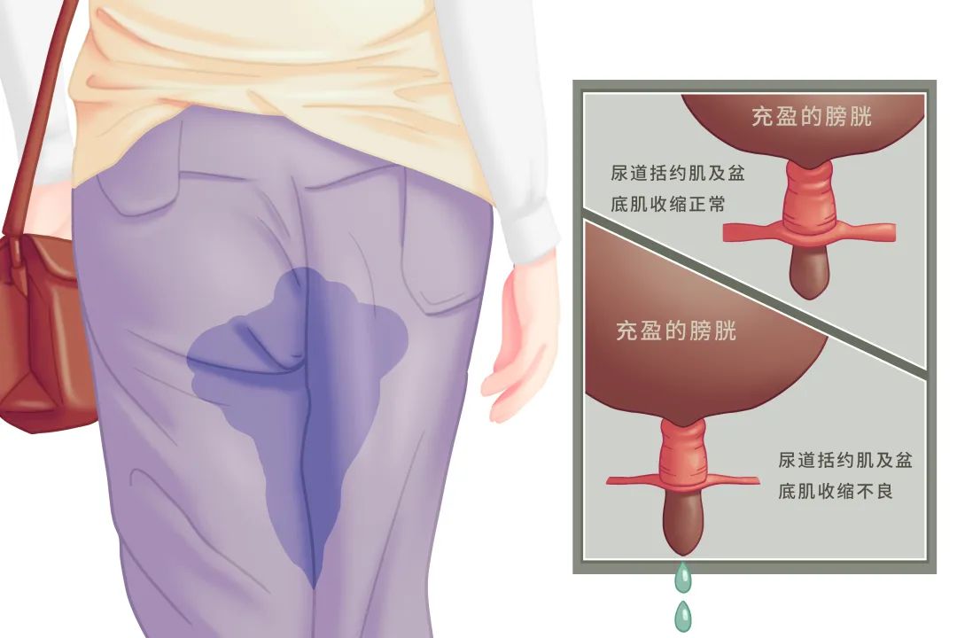 65岁阿姨因漏尿常穿纸尿裤！医生表示：这是压力性尿失禁