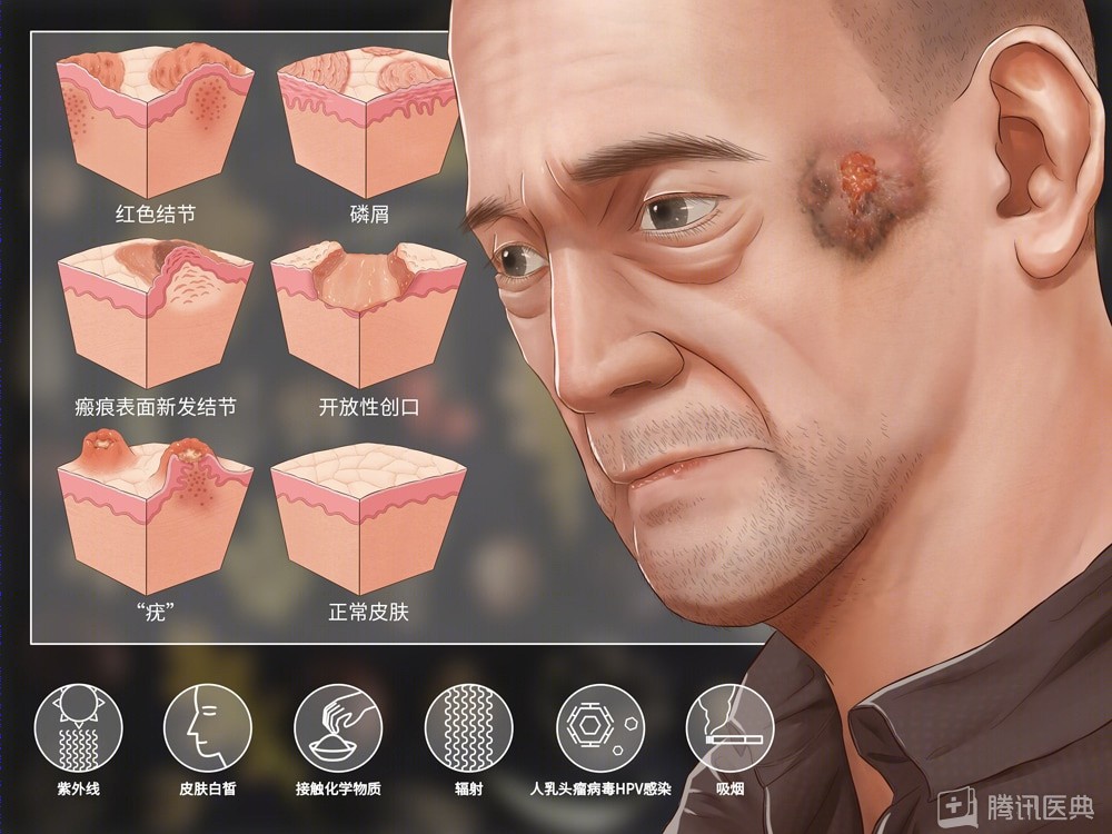 精准放射治疗成功铲除颌面部“鸡蛋大”皮肤鳞癌